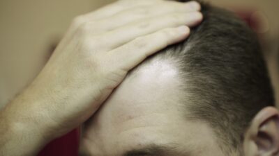 En la mayoría de los casos, no implica riesgos para la salud y solo tiene impacto estético