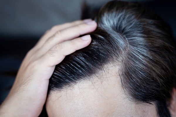 La poliosis o poliosis circumscripta se caracteriza por la aparición de áreas localizadas de pelo con ausencia de pigmento