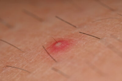 La foliculitis puede aparecer en cualquier persona y existen diversos tipos.